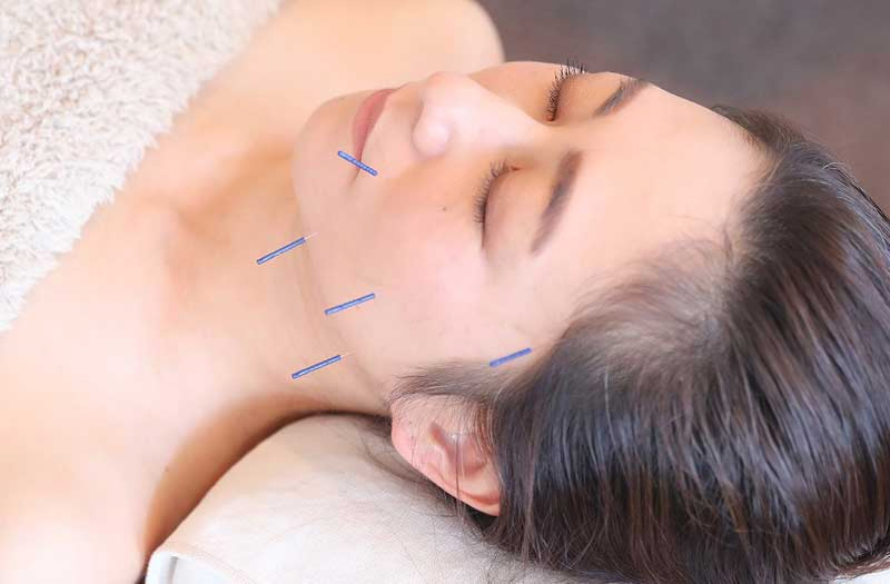 電気を流さない美容鍼の施術様子